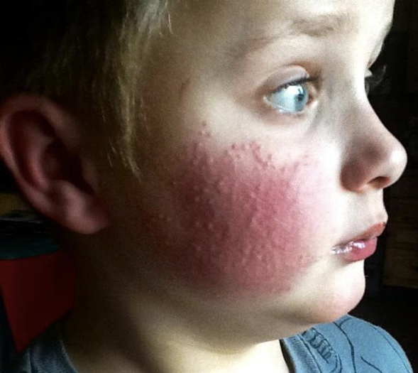 Physical Urticarias Rare Causes Of Hives You Should Be Aware Of Green Kids Doc
